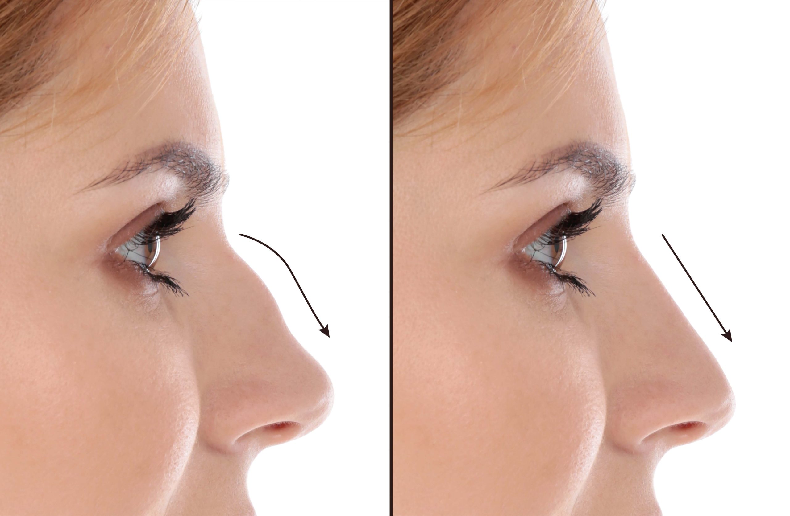 Best Rhinoplasty Surgeon In Turkey - MedicalCareFlow